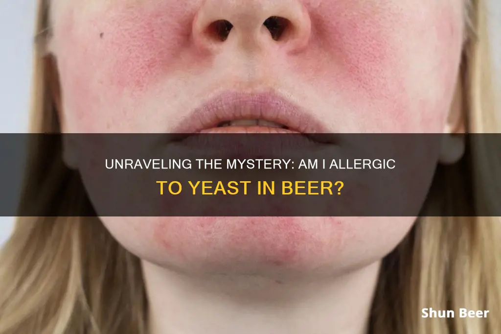 am i allergic to yeast in beer