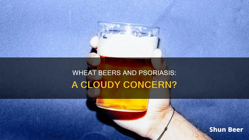 are cloudy wheat beers worse for psoriasis