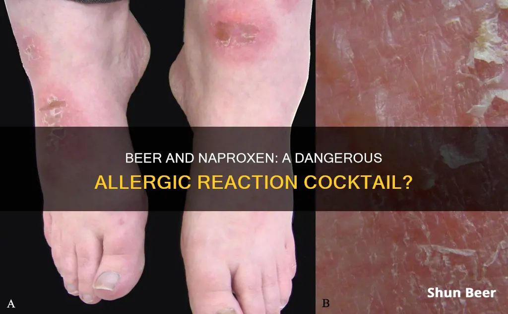 can drinking beer and naproxen give you an allergic reaction