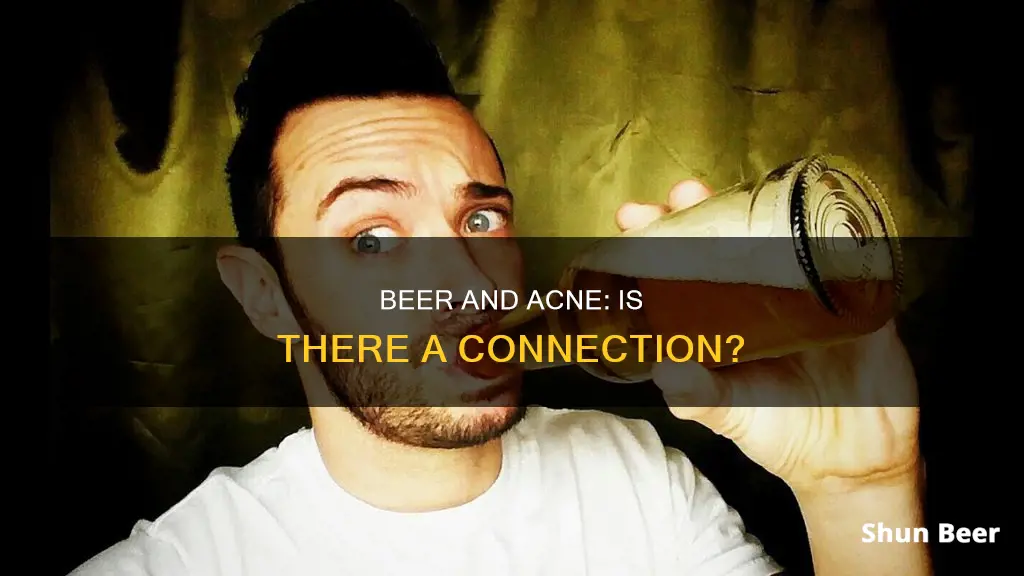 can drinking beer cause acne