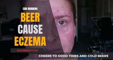 Beer and Eczema: Is There a Connection?