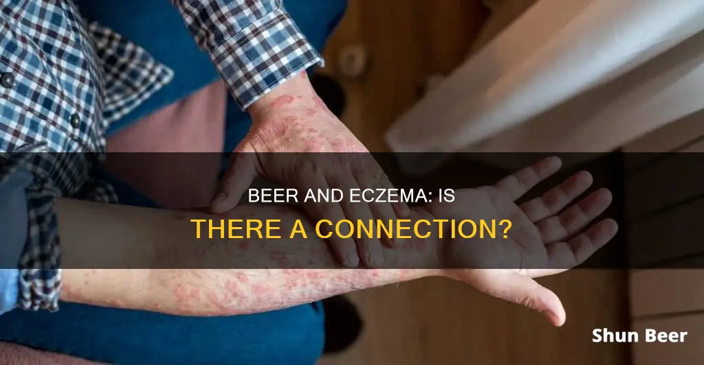 can drinking beer cause eczema