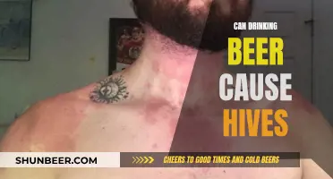 Beer and Hives: Is There a Connection?