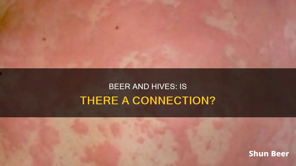 can drinking beer cause hives