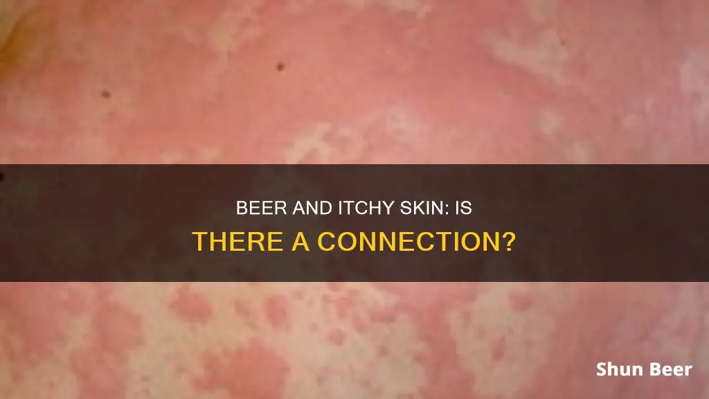 can drinking beer cause itchy skin