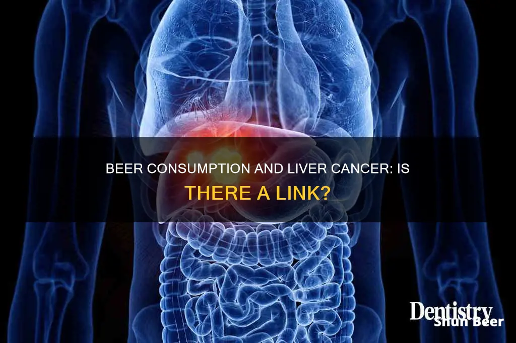 can drinking beer cause liver cancer