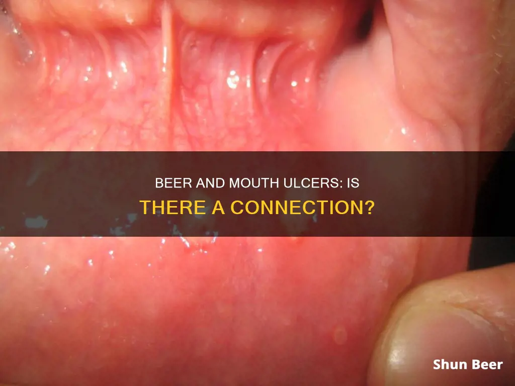 can drinking beer cause mouth ulcers