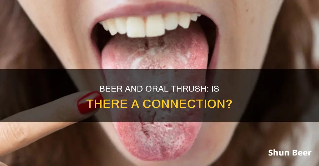 can drinking beer cause oral thrush