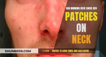 Beer Drinking: Red Patches on the Neck, What's the Link?