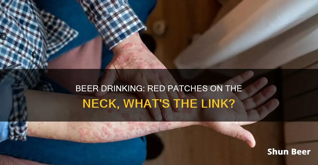 can drinking beer cause red patches on neck