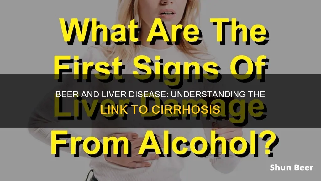 can drinking beer cause sirosis of the liver