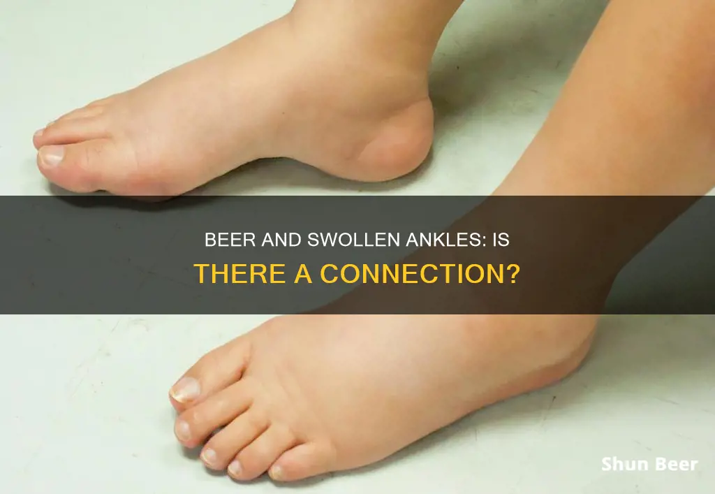 can drinking beer cause swollen ankles