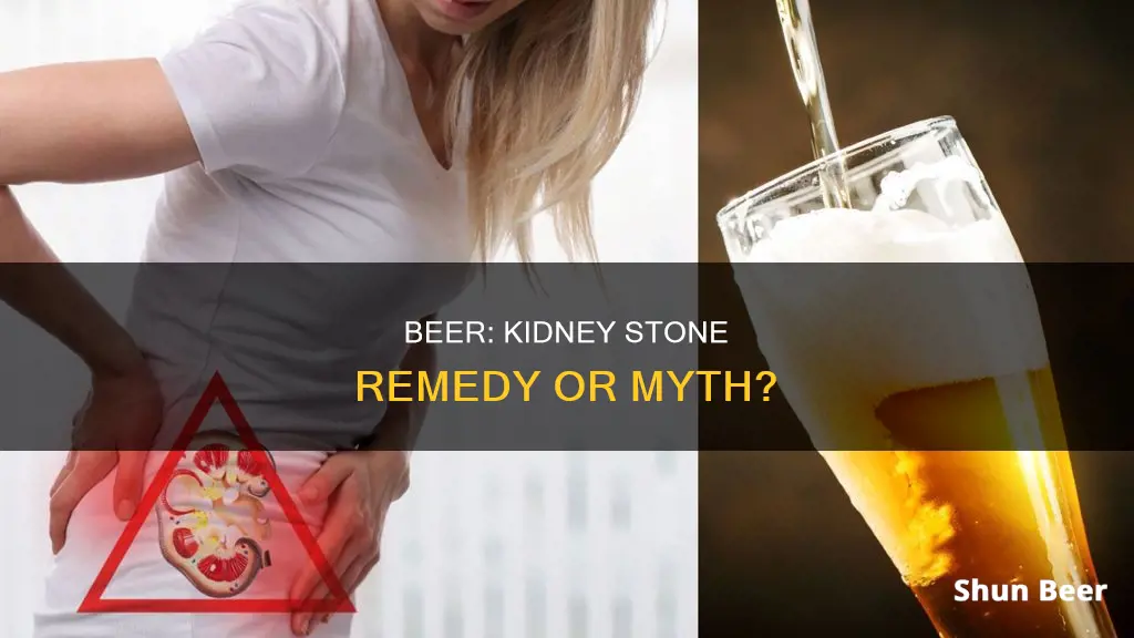 can drinking beer flush out kidney stones