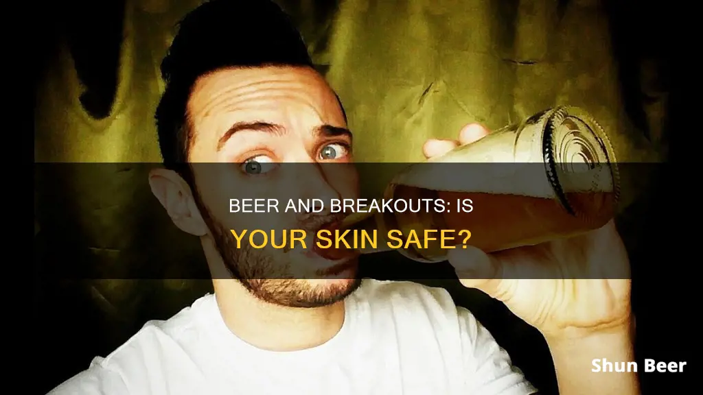 can drinking beer make you breakout