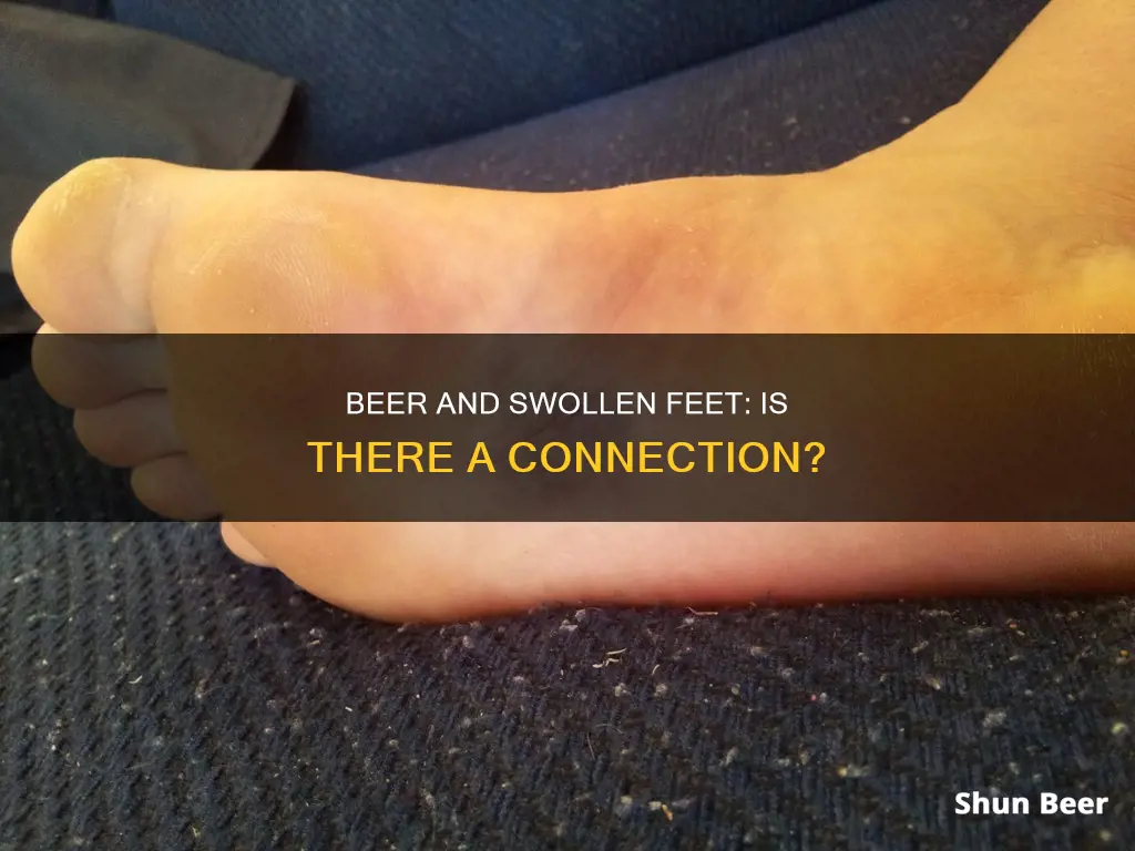 can drinking beer make your feet swell