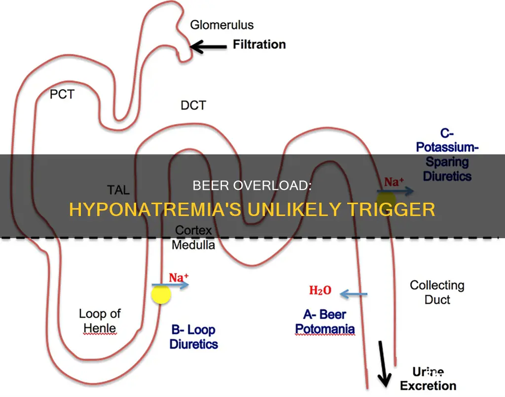 can drinking too much beer cause hyponatremia