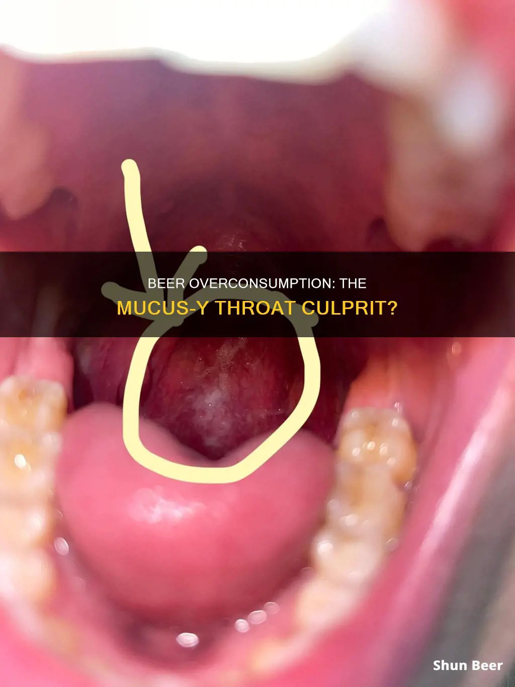 can excessive beer drinking cause mucus in throat