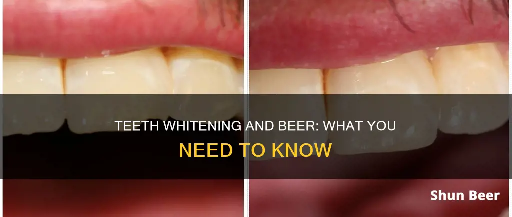 can I drink beer after getting my teeth whitened