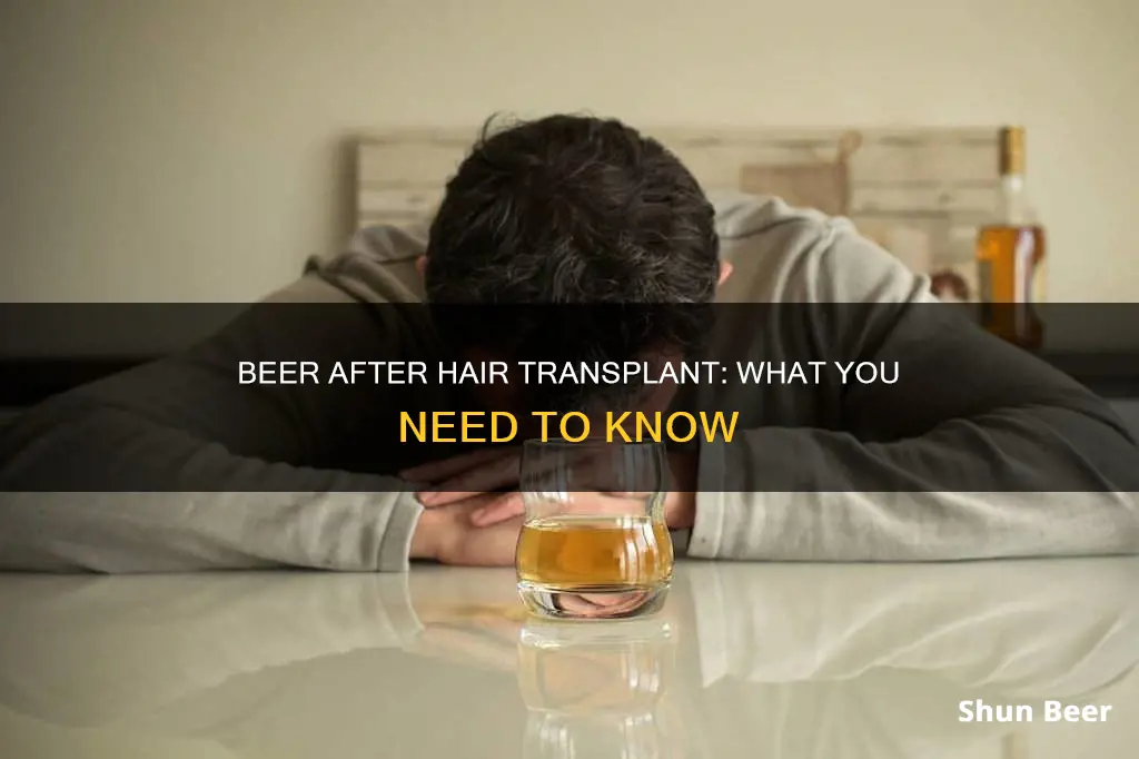 can I drink beer after hair transplant