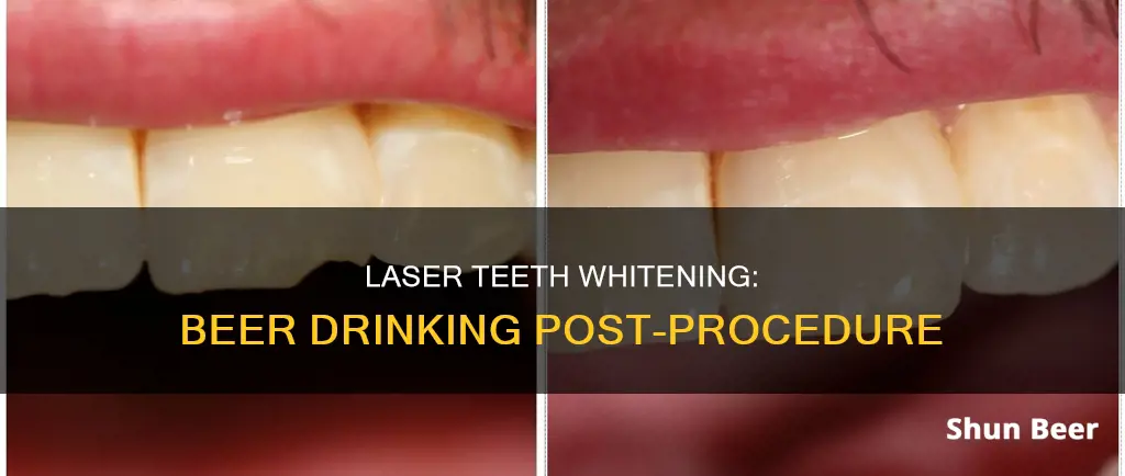 can I drink beer after laser teeth whitening