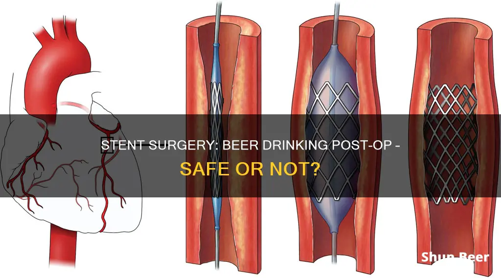 can I drink beer after stent surgery