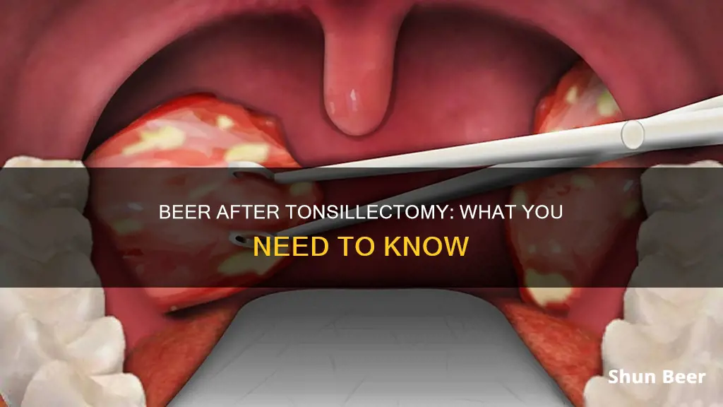 can I drink beer after tonsillectomy