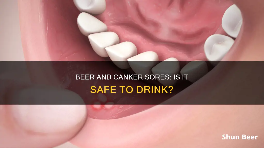 can I drink beer if I have a canker sore