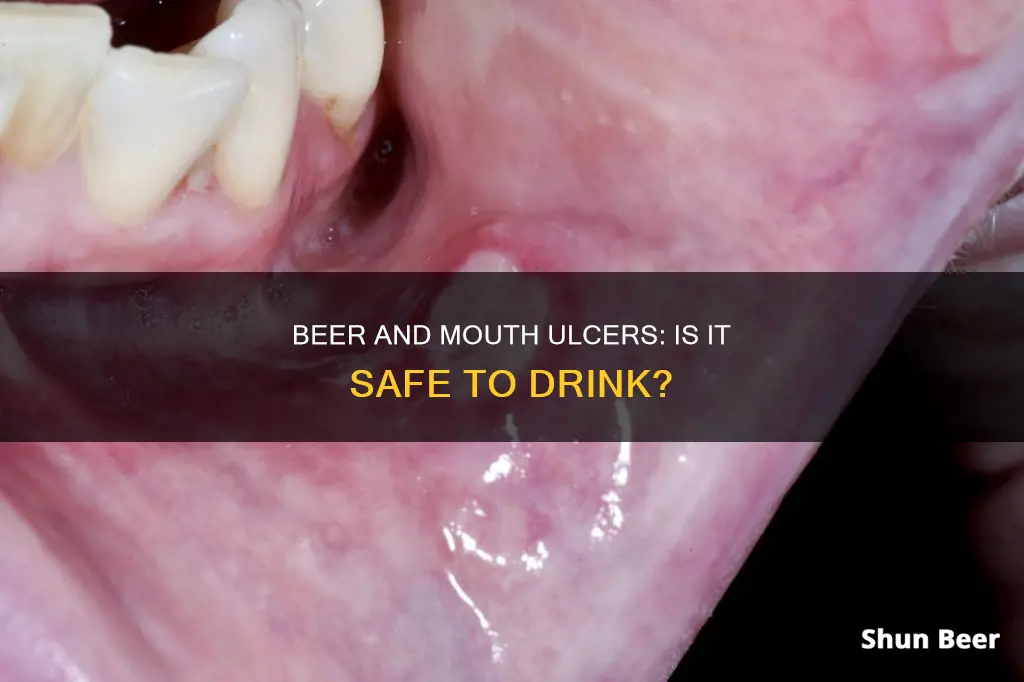 can I drink beer in mouth ulcer