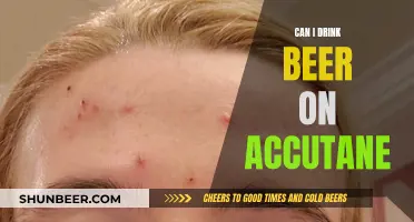 Accutane and Alcohol: Is Beer-Drinking Safe?