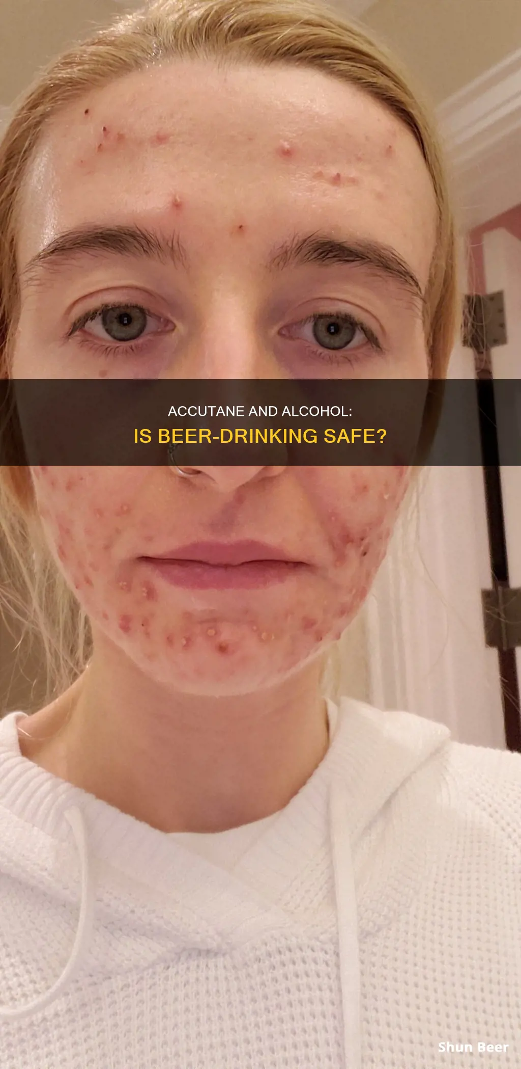 can I drink beer on accutane