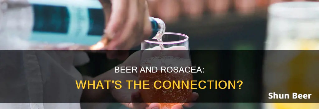 can I drink beer with rosacea