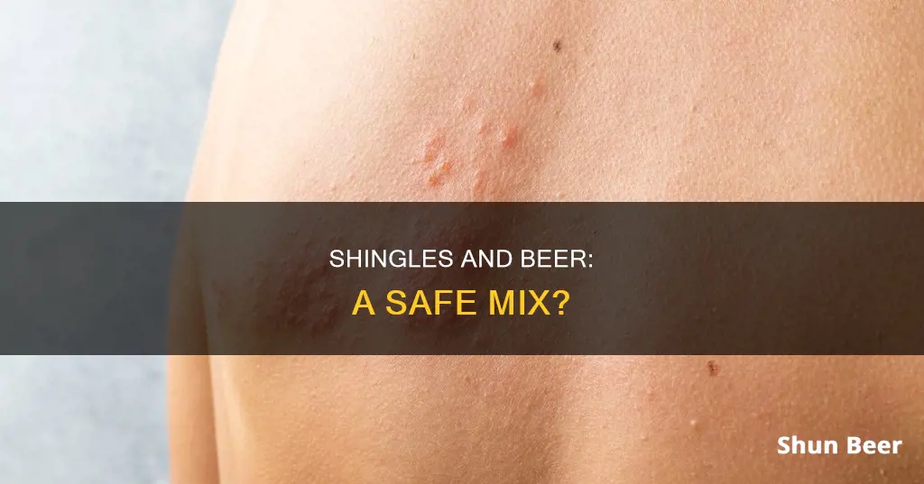 can I drink beer with shingles