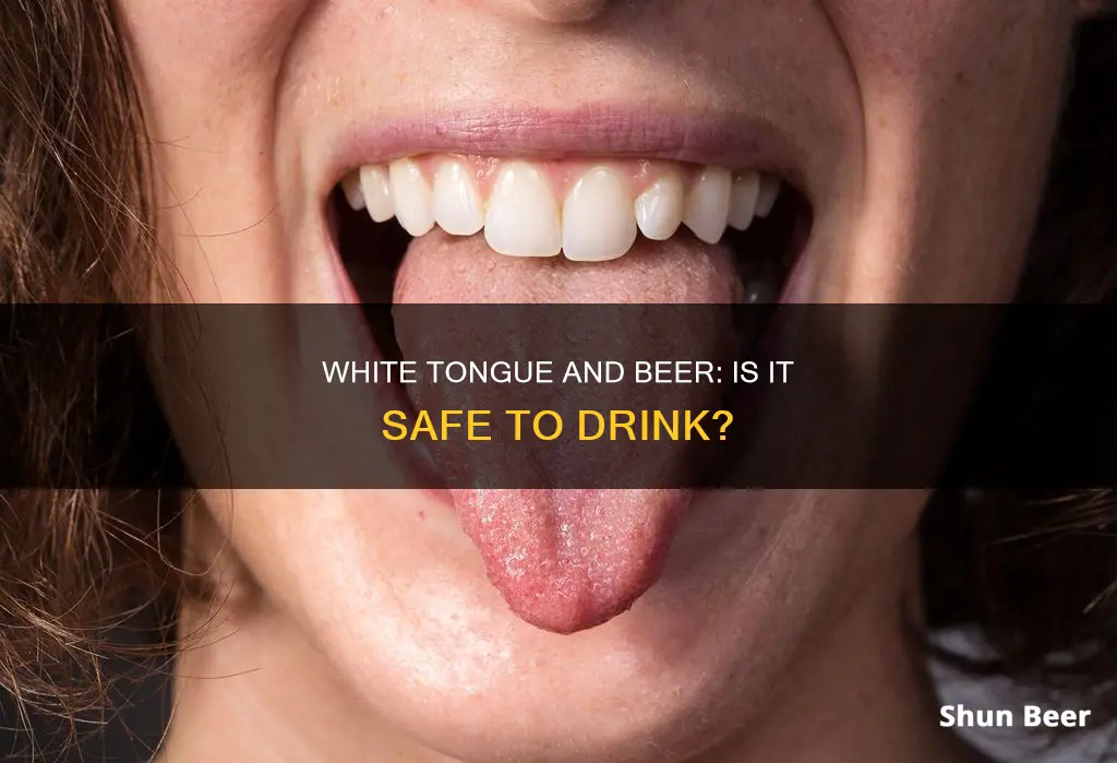 can I still drink beer with white tounge