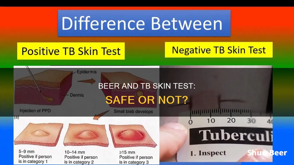 can you drink a beer during a tb skin test