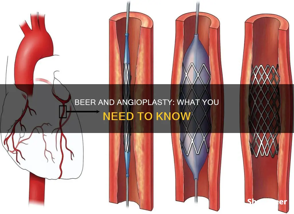 can you drink beer after angioplasty