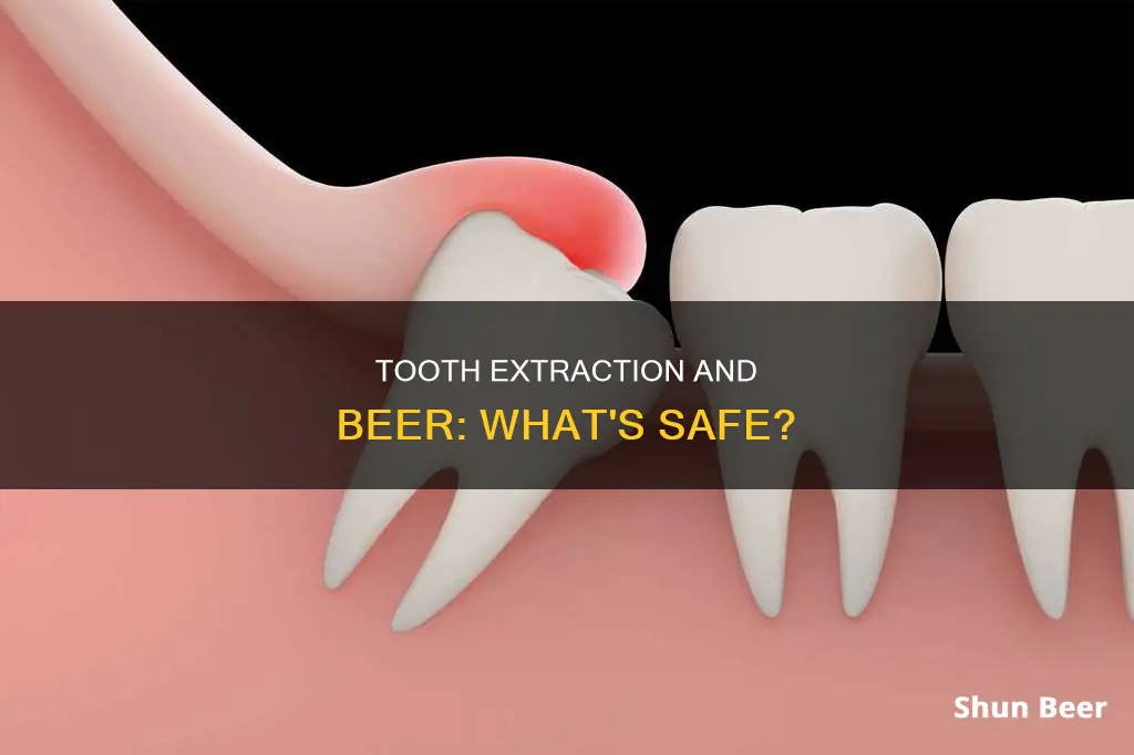 can you drink beer after getting a wisdom tooth pulled