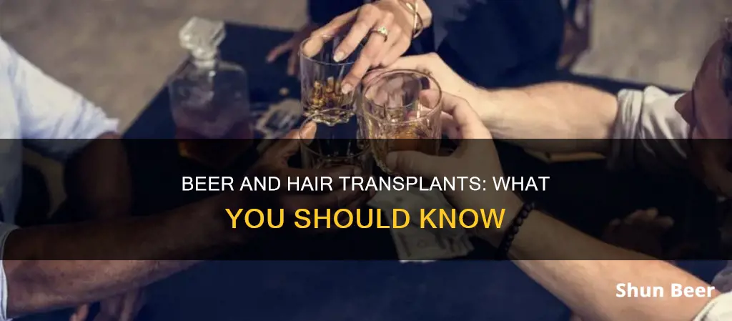 can you drink beer after hair transplant