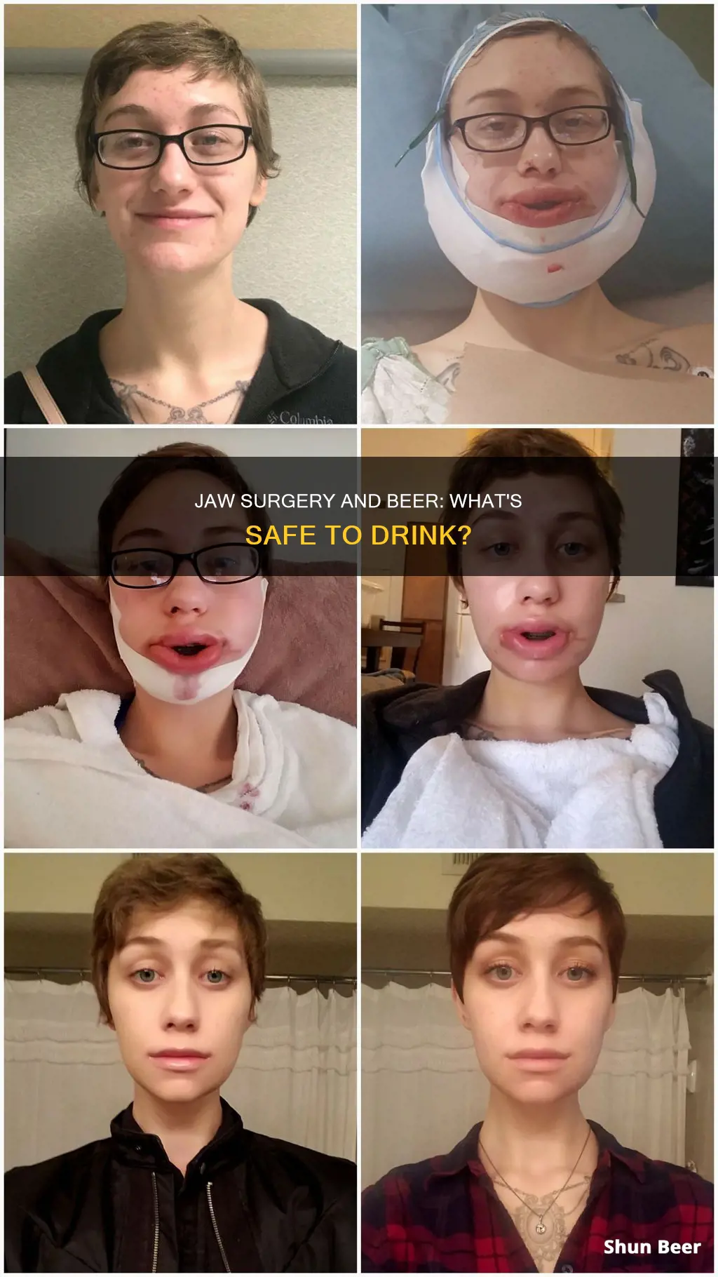 can you drink beer after jaw surgery