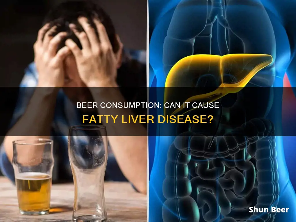 do I get fatty liver with drinking beer