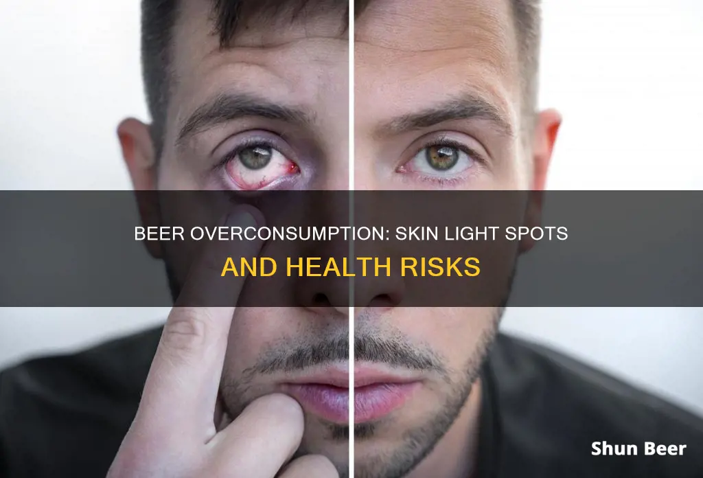 does drinking too much beer cause light spots on skin