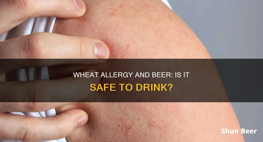 is beer acceptable for wheat allergy