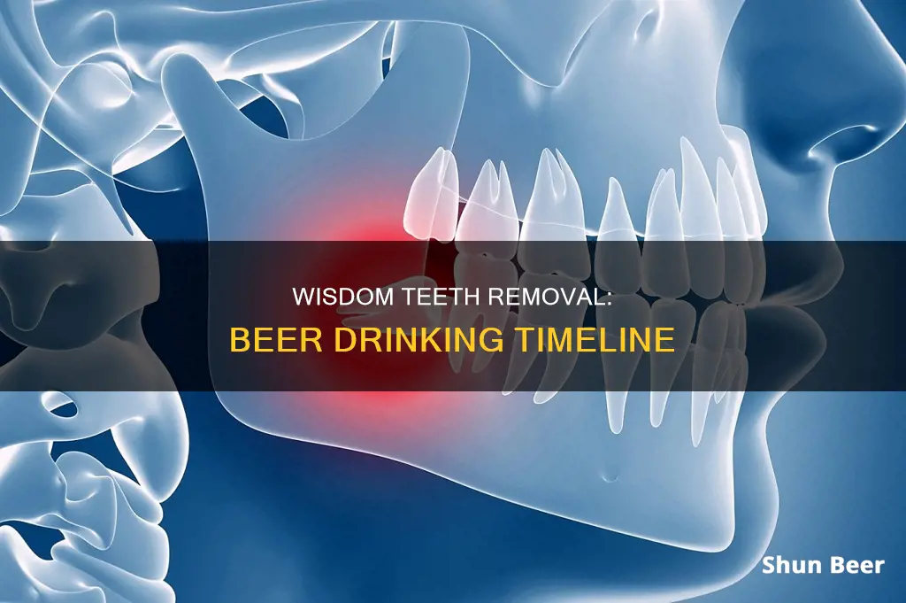 when can you drink beer after wisdom teeth removal